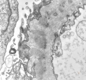 F,49y. | membranous glomerulopathy